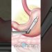 PreOp® Laparoscopic Gastric Sleeve Surgery  #preop #patienteducation #medicine #medical #weightloss