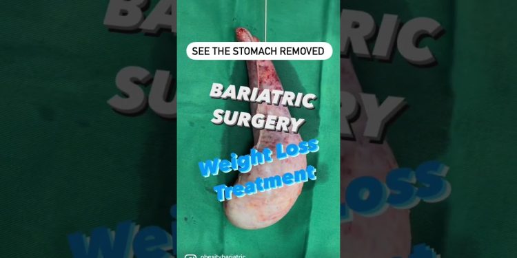 Weight Loss Operation in Surat – Bariatric Surgery In India